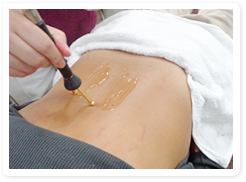 腰痛への微弱電流